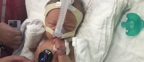 Baby in NICU at Victoria Hospital